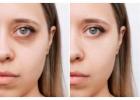 Best Dark Circles Treatment in Islamabad