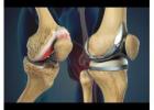 Affordable Knee Replacement Surgeon in Vaishali Nagar – Dr. Arvind Asopa