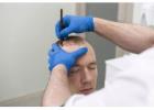 Trusted Solutions for Hair Implants in Manchester by Dr Ditta Hair Transplants
