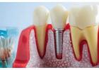 Restore Your Smile with Advanced Dental Implants in Pickering