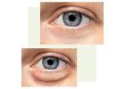 Expert Eyelid Surgery in Durham Restore a Youthful, Refreshed Look
