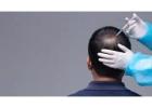 Consult the Best Dermatologist for Hair Loss in Shalimar Bagh