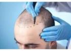 Best Hair Transplant Clinic