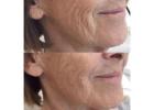Envy Aesthetics: Skin Boosters Injections for Radiant & Youthful Skin