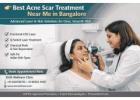 Best Acne Scar Treatment Near Me in Bangalore