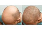 Hair Transplant Treatment