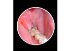 How Wisdom Teeth Infection Removal Helps Pain Fast