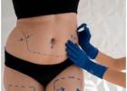 Non-surgical Liposuction Dubai - Dr Mohan Plastic Surgeon