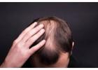 QR678 Hair Treatment in Pune for Hair Loss and Regrowth Support