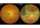 How to Choose the Best Retina Doctor for Your Eye Health