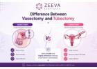 Difference between Vasectomy and Tubectomy in Reproductive Healthcare