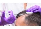 PRP Hair Treatment