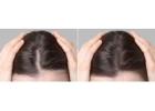 Exosome Hair Treatment