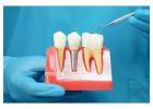 Why Choose HRI Angled Hex Abutment for Implants