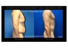 Tighten Up with Loose Skin Surgery New York