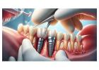 Siiodentimplants innovation in dental implants for precision care