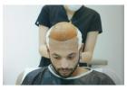 Best Sapphire FUE Hair Transplant in Turkey – UniqueEra Clinic