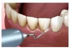 Keep Your Smile Bright with the Best Teeth Scaling in Islamabad