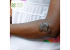 Effective Treatment for Keloids in Ghana – Book Now at CCS Ghana