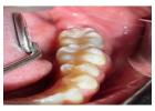 Full Mouth Dental Implants in Mexico with Teeth Savers