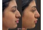 Nonsurgical Rhinoplasty in Islamabad