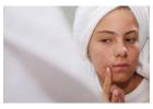 Effective Acne Treatment in Kolkata – Clear Skin, Renewed Confidence!