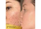Acne Scars Treatment in Islamabad