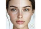 Melasma Treatment in Islamabad: What You Need to Know
