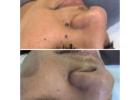 Skin tag removal clinic Goodmayes