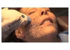 IPL (Intense Pulsed Light) - Mid Florida Dermatology & Plastic Surgery