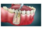 Agrawal Dental Clinic | Trusted Root Canal Dental Clinic in Thane
