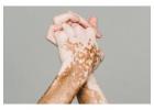 Effective Vitiligo Treatment in Hauz Khas at Iksana Wellness