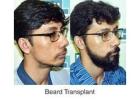 Dr Ditta Hair Transplants Performs Expert Beard Transplants in Manchester