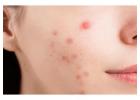 Acne Scars Treatment in Hauz Khas