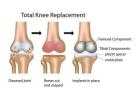 Total Knee Replacement Surgery in Mumbai | Divi Orthopaedic