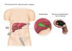 Robotic Gallbladder Surgery in Delhi
