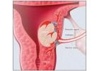 Uterine Fibroid Embolization Near Me: Find Care at USA Fibroid Centers