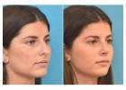 Best Clinic for Rhinoplasty in Islamabad