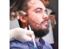 Best Beard Transplant in Turkey – UniquEra Clinic