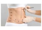 Tummy Tuck in Islamabad to Remove Stubborn Fat