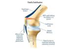 Patella Fracture Support for Safer Recovery