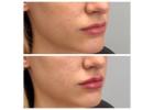 Professional Jawline Sculpting West Loop Chicago - Opulence Chicago LLC