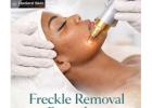 Natural-Looking Results with Freckle Removal in Harlem