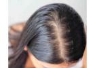 Best Hair Clinic in Noida Offering Safe & Herbal Hair Care Solutions