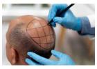 Hair transplant clinics in Faridabad