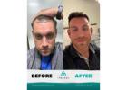 Trusted Hair Transplant Clinic in Istanbul