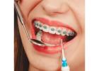 Smile Transformation Starts with Braces Treatment in Chembur