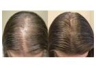 Natural Hair Regrowth Methods to Regrow Hair Naturally