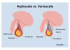 Advanced Varicocele Embolization – Minimally Invasive Treatment for Varicocele