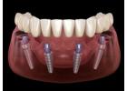 All-on-4 Dental Implants in Tijuana, Mexico – Affordable, Life-Changing Results!